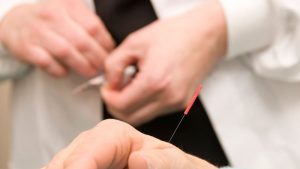 accupuncture