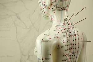 How to Know if Acupuncture Is Right for You | Jersey Pain Specialists